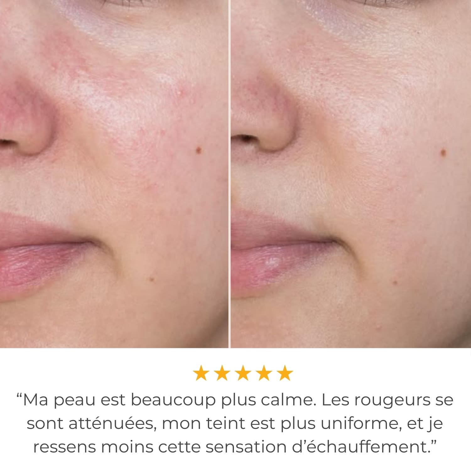 ClearPulse™ 2.0 - Haute Fréquence Thérapeutique Anti-Acné