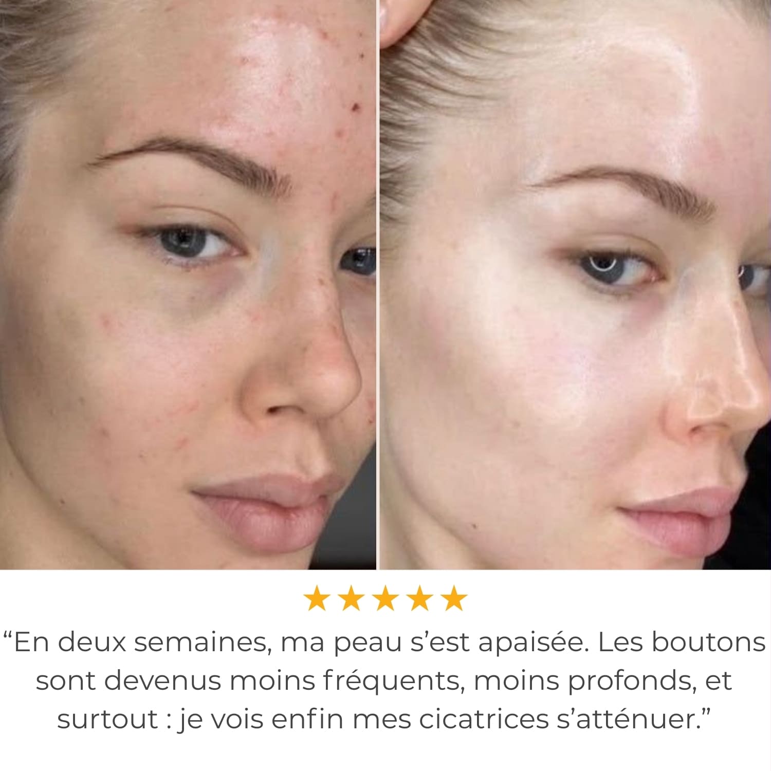 ClearPulse™ 2.0 - Haute Fréquence Thérapeutique Anti-Acné