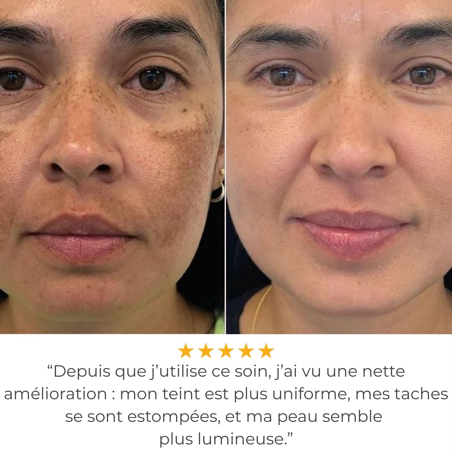 ClearPulse™ 2.0 - Haute Fréquence Thérapeutique Anti-Acné